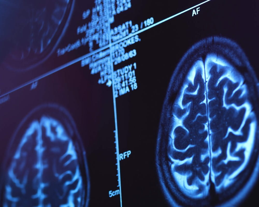 Brain scan