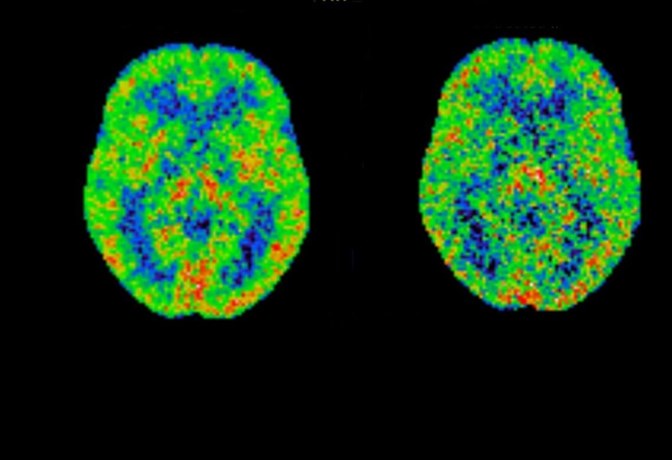 Positron emission tomography (PET) brain scans showing differences between a long duration and a short duration of untreated major depression