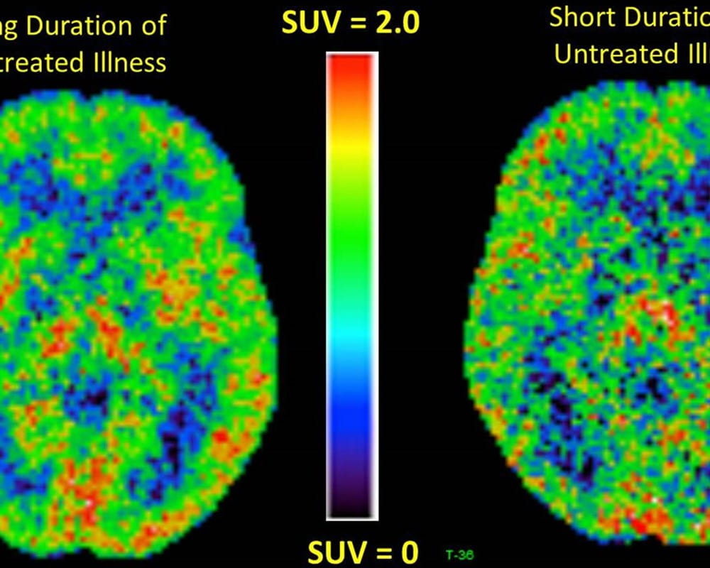 Positron emission tomography (PET) brain scans in people with long or short durations of depression