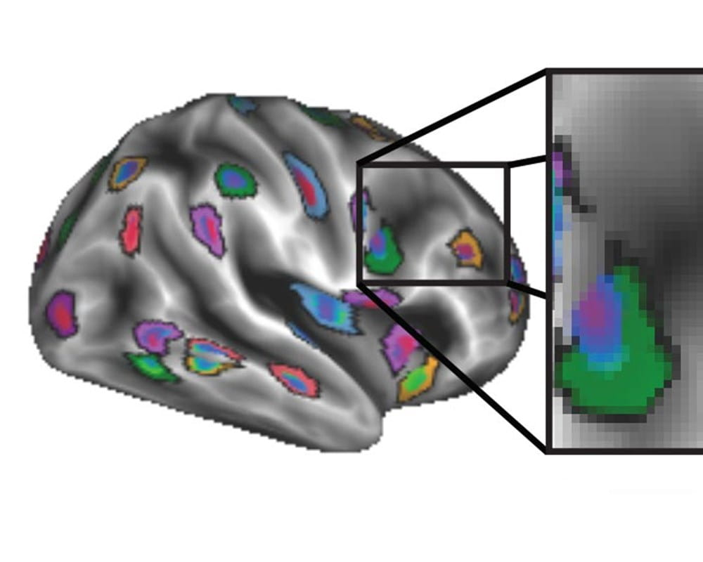 Illustration showing brain image after applying personalized mapping