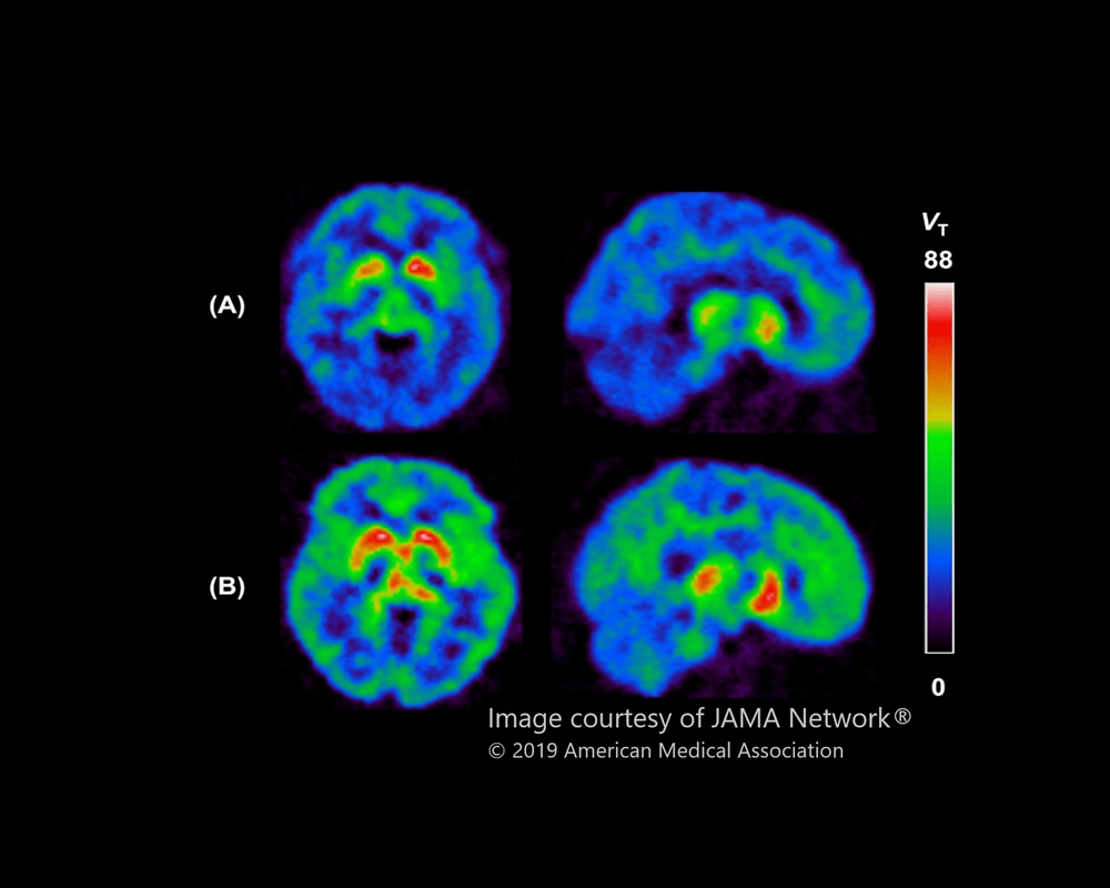 Brain images showing MAO-B levels in a depression study by CAMH's Dr. Jeffrey Meyer
